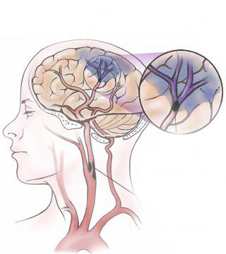 STROKE