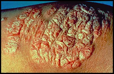 http://www.interhomeopathy.org/images/gallery/IH300-psoriasis_plaque.jpg